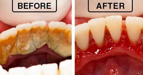 Làm thế nào để loại bỏ mảng bám và vôi răng Làm thế nào để loại bỏ mảng bám và vôi răng