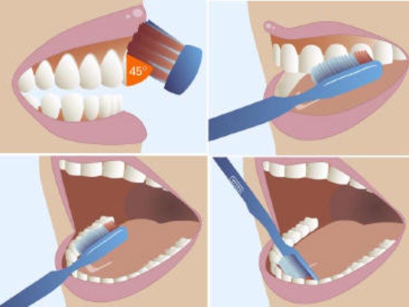 Làm thế nào để vệ sinh răng miệng đúng cách sau khi niềng răng Làm thế nào để vệ sinh răng miệng đúng cách sau khi niềng răng