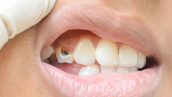 Làm thế nào điều trị răng chết Làm thế nào điều trị răng chết