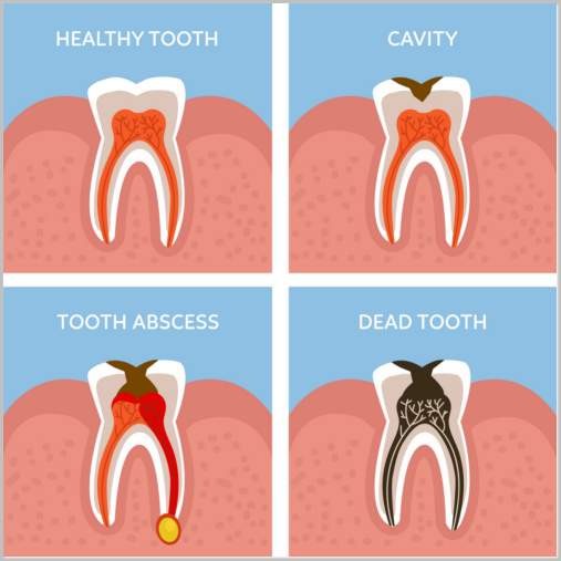 Làm thế nào điều trị răng chết Làm thế nào điều trị răng chết