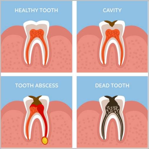 Làm thế nào điều trị răng chết