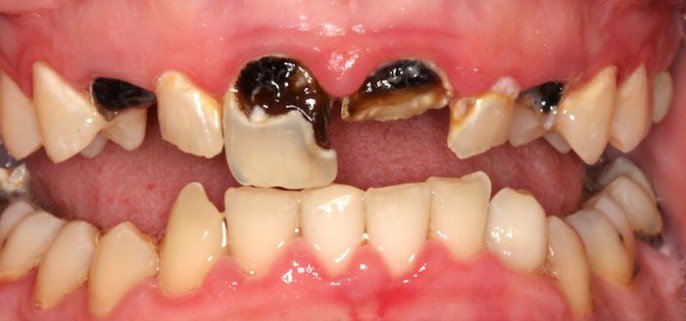 Làm thế nào điều trị răng chết Làm thế nào điều trị răng chết
