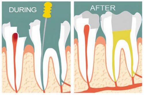 Lấy tủy răng có ảnh hưởng đến sức khỏe không
