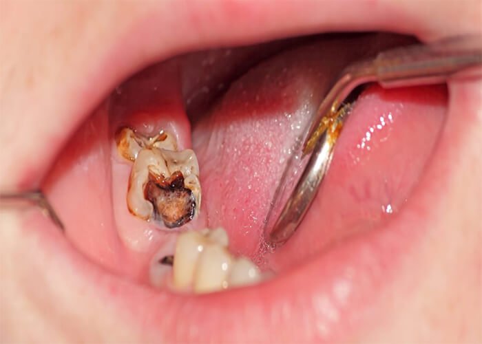 Lấy tủy răng có ảnh hưởng đến sức khỏe không Lấy tủy răng có ảnh hưởng đến sức khỏe không