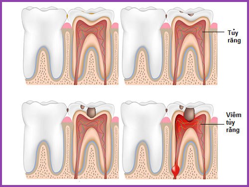 Lấy tủy răng có ảnh hưởng đến sức khỏe không