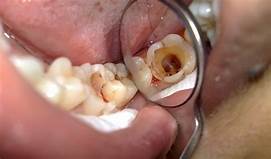 Lấy tủy răng có ảnh hưởng đến sức khỏe không Lấy tủy răng có ảnh hưởng đến sức khỏe không