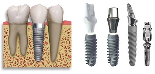 nên cấy ghép implant loại nào tốt 