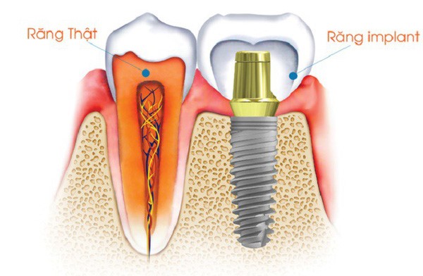 nên cấy ghép implant loại nào tốt 