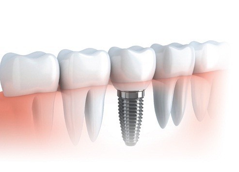 nên cấy ghép implant loại nào tốt 