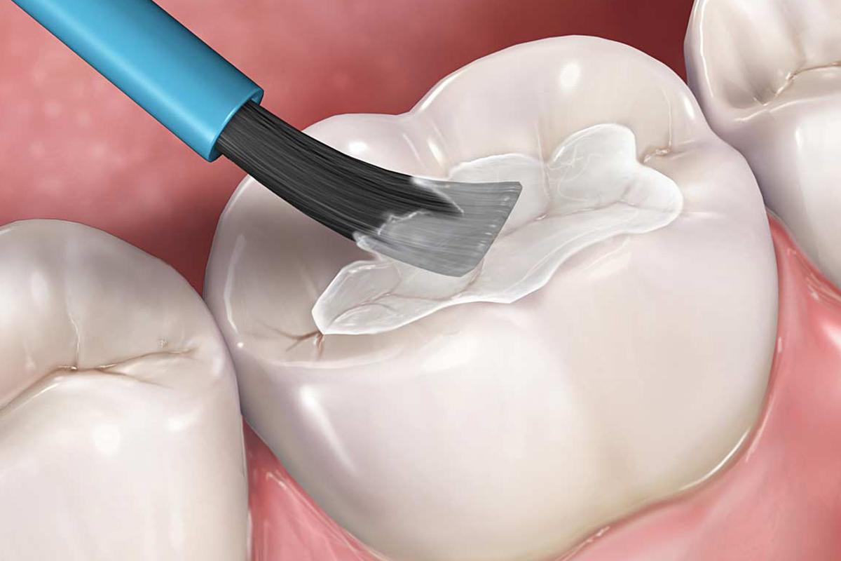 Nên và không nên làm gì sau khi trám răng thẩm mỹ Nên và không nên làm gì sau khi trám răng thẩm mỹ