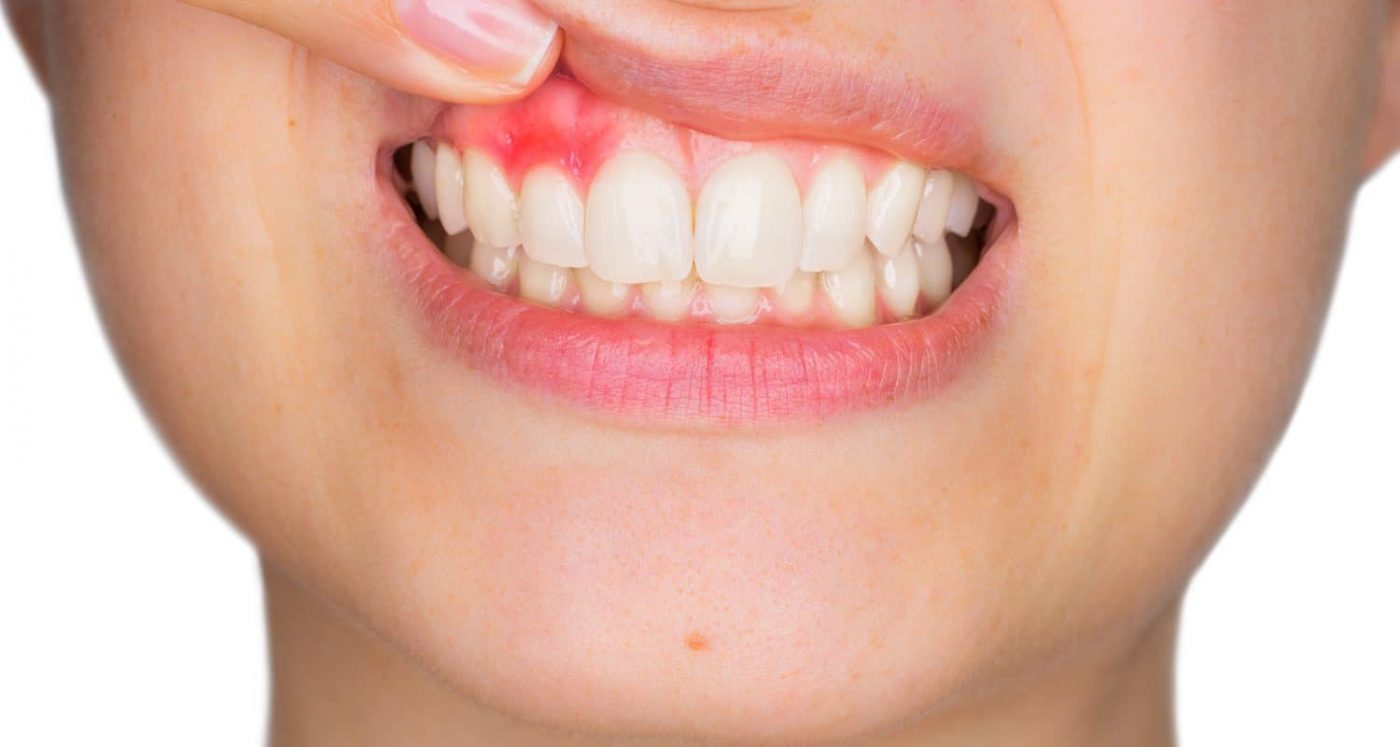 Nguyên nhân và biện pháp phòng ngừa áp xe răng