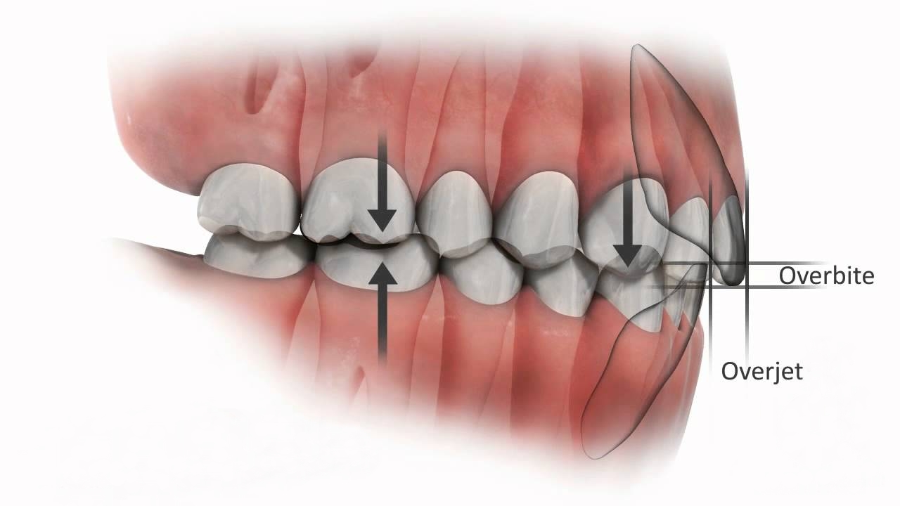 Nguyên nhân và cách khắc phục răng bị đau sau khi trám