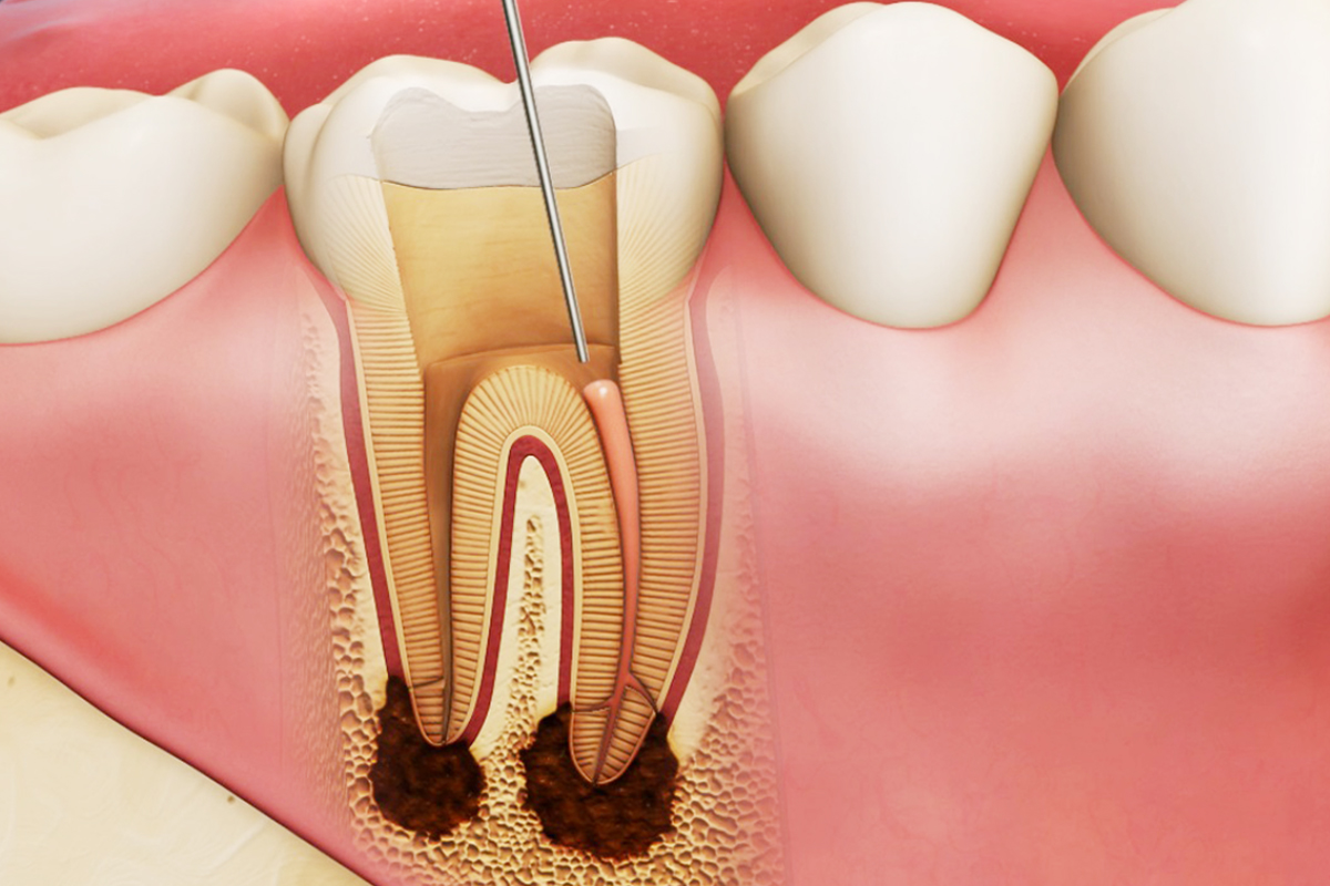 Nguyên nhân và cách khắc phục răng bị đau sau khi trám