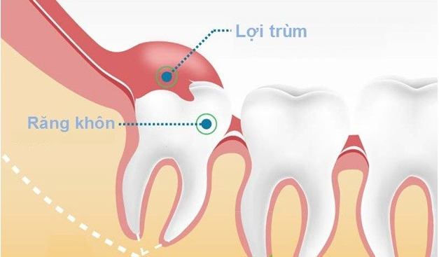 nhổ răng khôn nhổ răng khôn