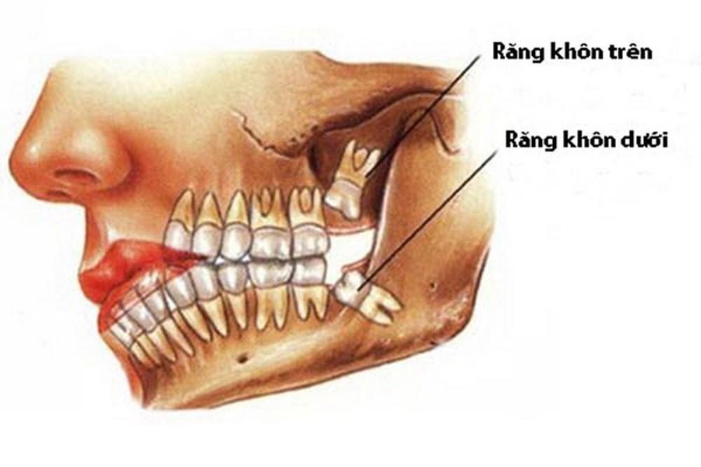 Nhổ răng khôn tại quận 10