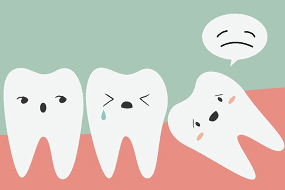 Nhổ răng số 8 có đau không Nhổ răng số 8 có đau không