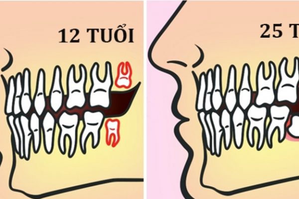 Nhổ răng số 8 có đau không Nhổ răng số 8 có đau không