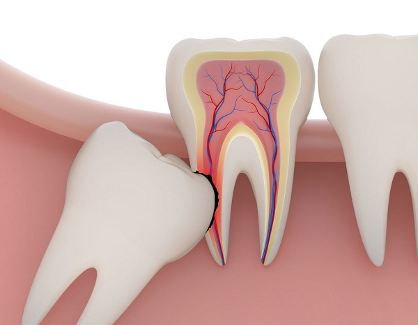 Những cách làm giảm đau cho răng khôn tại nhà
