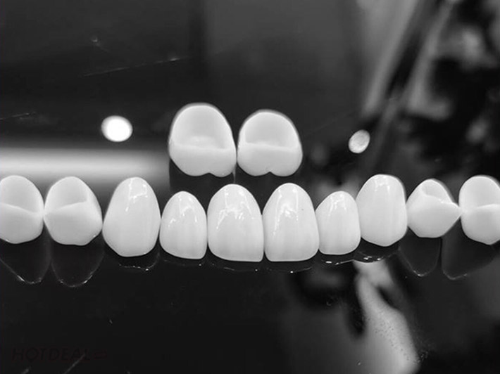 Những câu hỏi thường gặp nhất khi bọc răng sứ Những câu hỏi thường gặp nhất khi bọc răng sứ