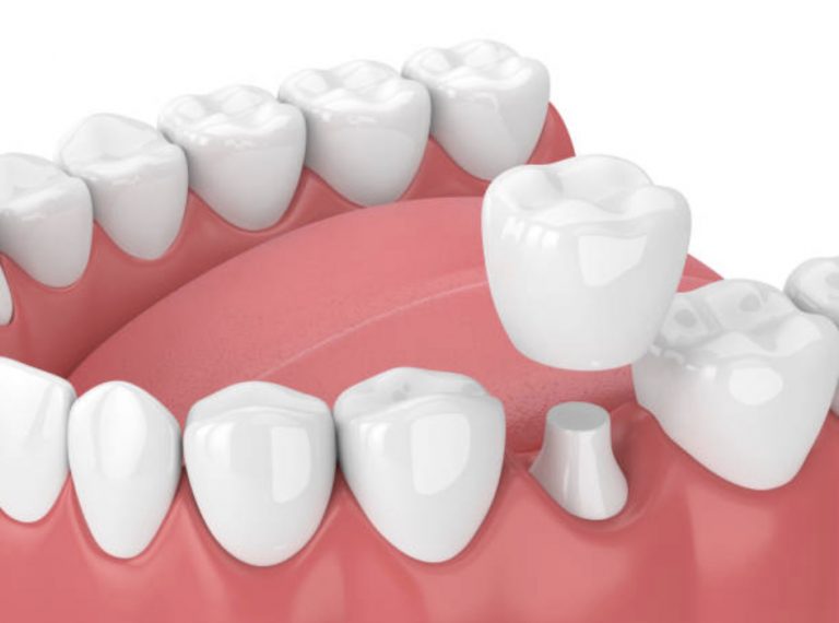 Những câu hỏi thường gặp nhất khi bọc răng sứ Những câu hỏi thường gặp nhất khi bọc răng sứ