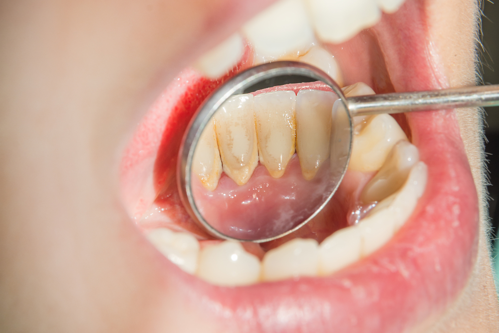 Những điểm cần lưu ý khi cạo vôi răng Những điểm cần lưu ý khi cạo vôi răng
