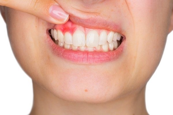 Những điểm cần lưu ý khi cạo vôi răng Những điểm cần lưu ý khi cạo vôi răng