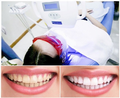 Những điều bạn cần biết về dịch vụ tẩy trắng răng