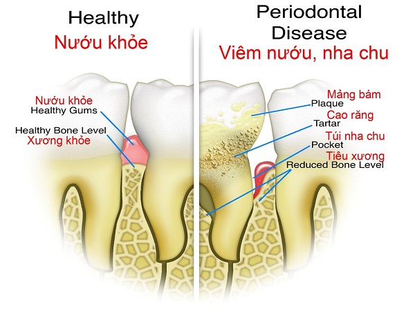 Những điều cần biết về bệnh viêm nha chu