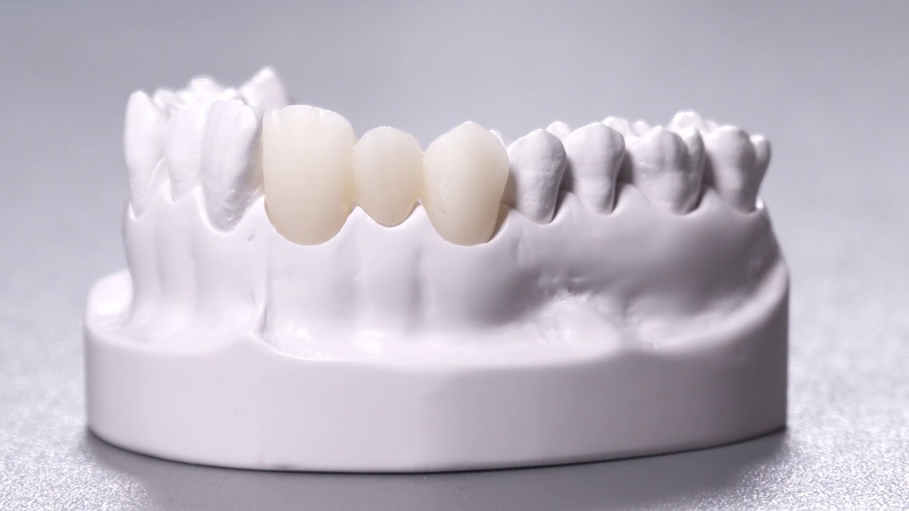 Những điều cần biết về bọc răng sứ Cercon HT