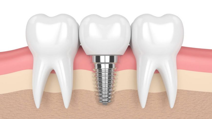 Những điều cần chú ý sau khi trồng răng implant