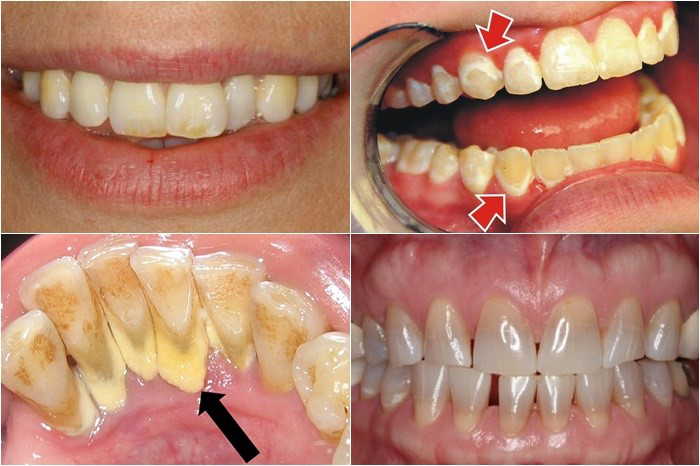 Những điều cần lưu ý khi bọc răng sứ