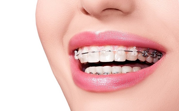 Những điều chưa biết về niềng răng Những điều chưa biết về niềng răng