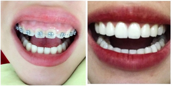 Những điều chưa biết về niềng răng Những điều chưa biết về niềng răng