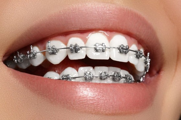 Những điều chưa biết về niềng răng Những điều chưa biết về niềng răng