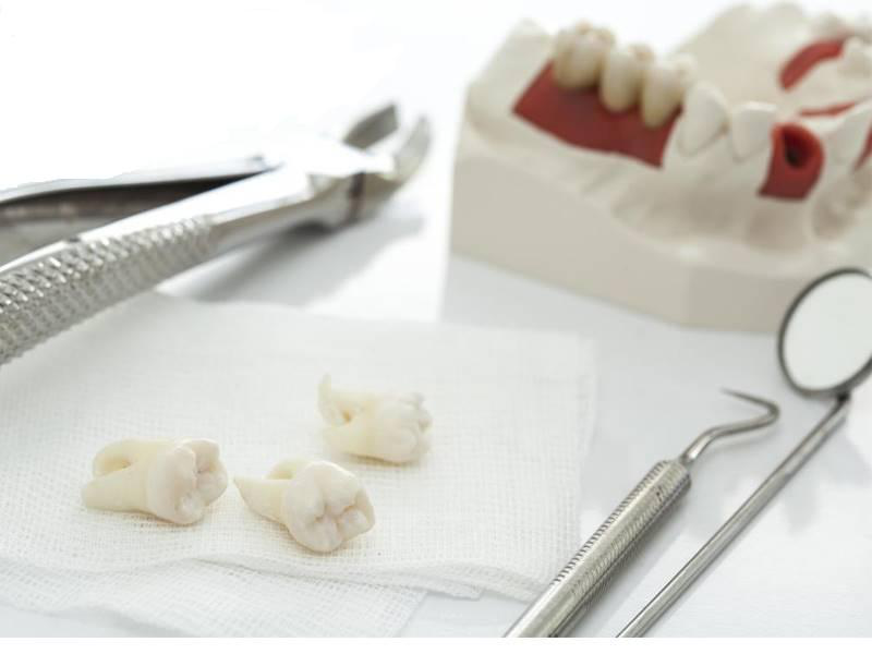 Những gì bạn mong đợi trước, trong và sau khi loại bỏ răng khôn Những gì bạn mong đợi trước, trong và sau khi loại bỏ răng khôn