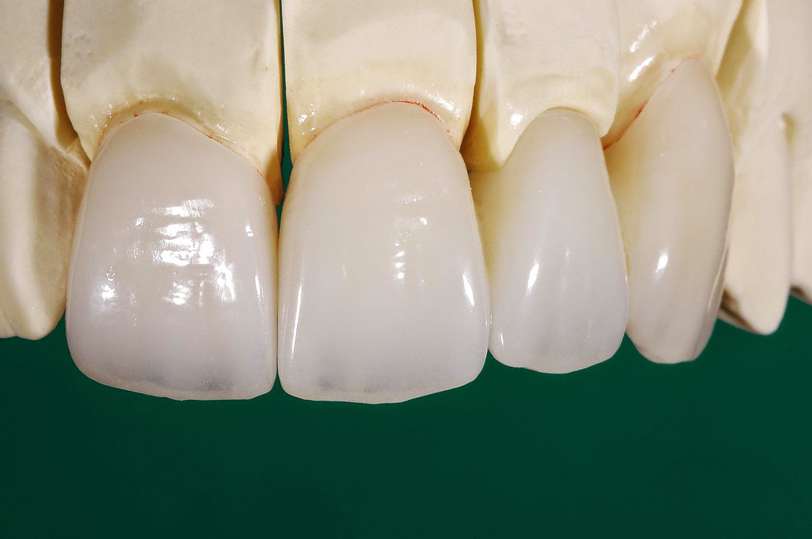 Những loại răng sứ tốt nhất hiện nay Những loại răng sứ tốt nhất hiện nay