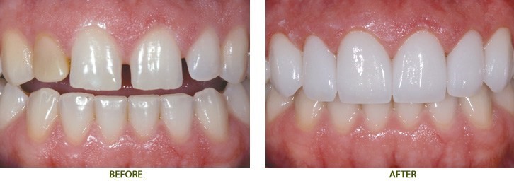 Những loại răng sứ tốt nhất hiện nay Những loại răng sứ tốt nhất hiện nay