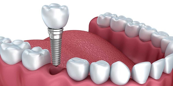 Những lợi ích của việc trồng implant mang lại