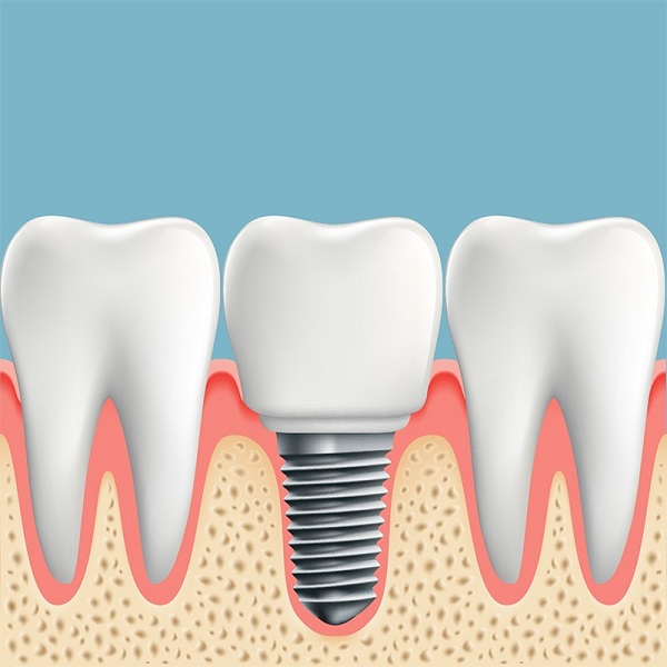 Những lợi ích của việc trồng implant mang lại Những lợi ích của việc trồng implant mang lại