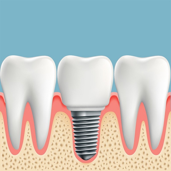 Những lợi ích của việc trồng implant mang lại