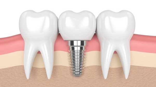 Những lợi ích của việc trồng implant mang lại Những lợi ích của việc trồng implant mang lại