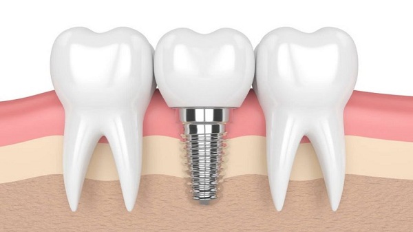 Những lợi ích của việc trồng implant mang lại