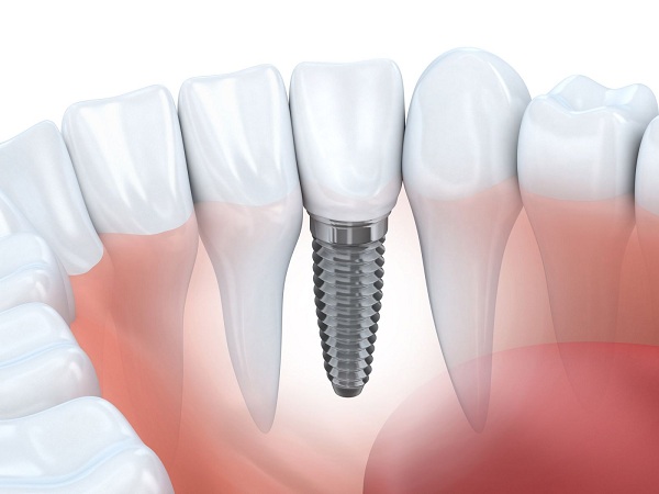 Những lợi ích của việc trồng implant mang lại