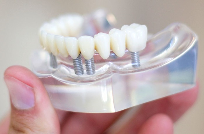 Những lợi ích của việc trồng implant mang lại