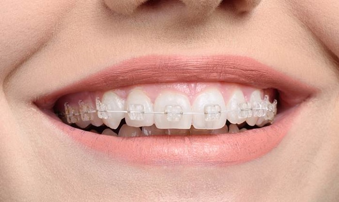 Những lợi ích không ngờ từ việc niềng răng Những lợi ích không ngờ từ việc niềng răng