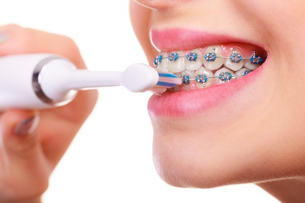Những lợi ích không ngờ từ việc niềng răng Những lợi ích không ngờ từ việc niềng răng