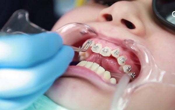 Những lợi ích không ngờ từ việc niềng răng Những lợi ích không ngờ từ việc niềng răng