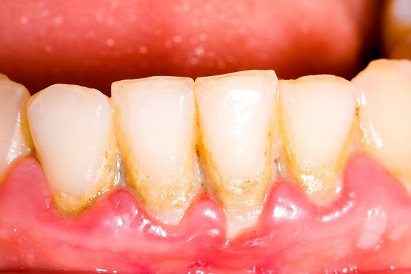 Những lưu ý khi cạo vôi răng bạn nên biết Những lưu ý khi cạo vôi răng bạn nên biết