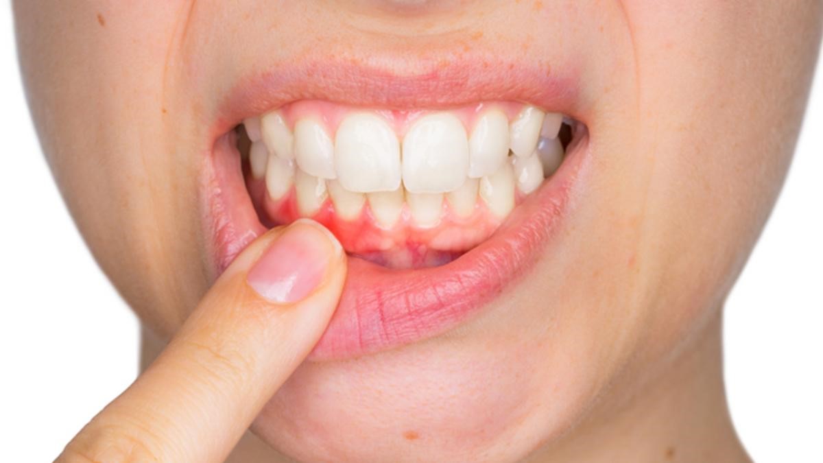 Những nguy hiểm tiềm tàng của bệnh nướu răng