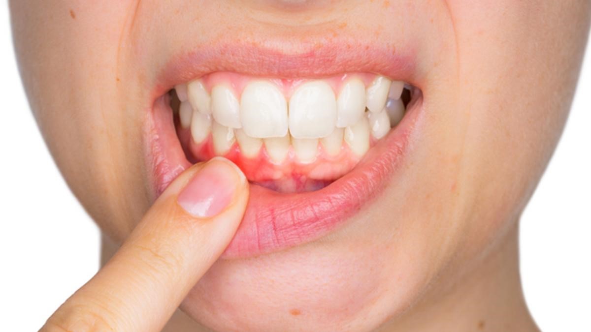 Những nguy hiểm tiềm tàng của bệnh nướu răng Những nguy hiểm tiềm tàng của bệnh nướu răng